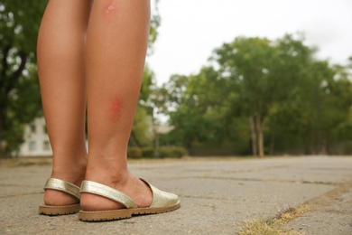 Woman with insect bites on legs in park, closeup. Space for text