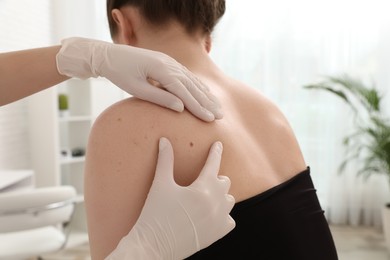 Dermatologist examining patient's birthmark in clinic, closeup