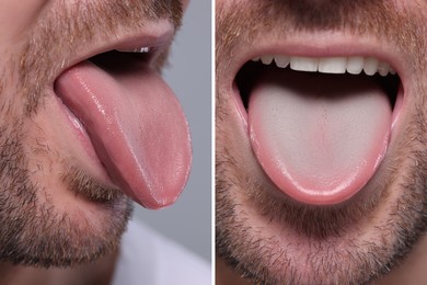 Image of Man showing his tongue before and after cleaning procedure, closeup. Tongue coated with plaque on one side and healthy on other, collage