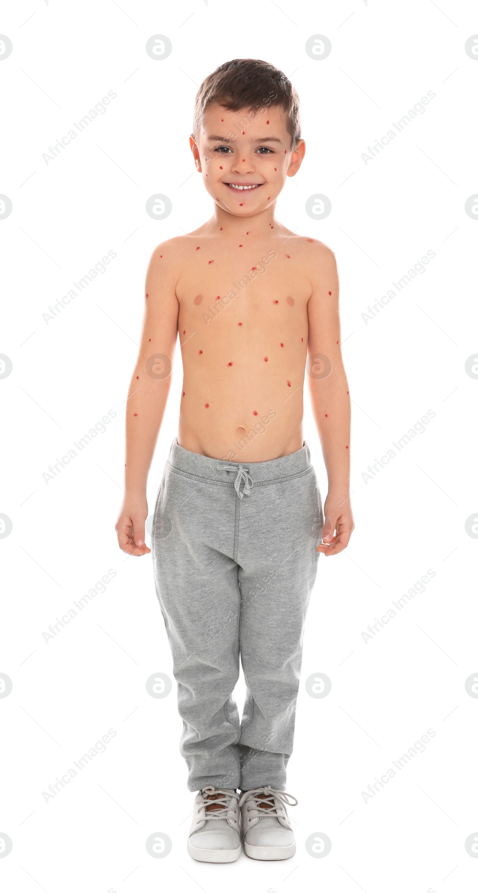 Photo of Little boy with chickenpox on white background