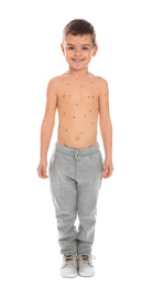 Little boy with chickenpox on white background