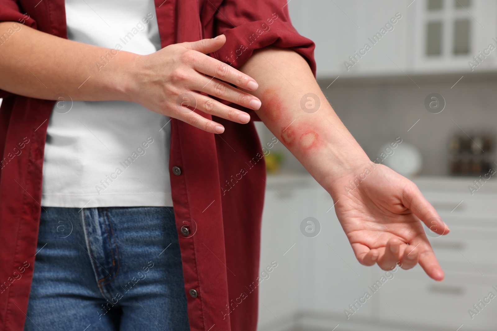 Photo of Woman with burns on her hand in kitchen, closeup