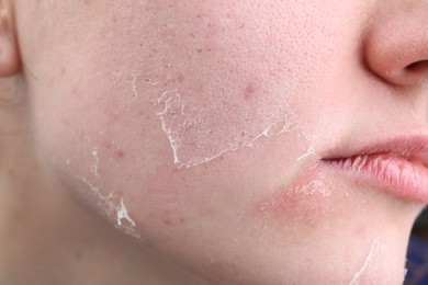 Photo of Woman with dry skin on face, closeup