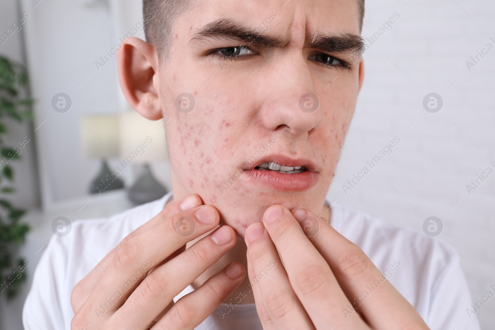 Photo of Upset young man touching pimple on his face indoors. Acne problem