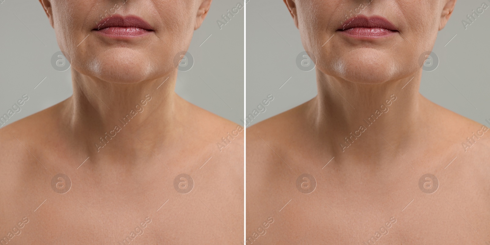 Image of Collage with photos of woman before and after cosmetic procedure on grey background, closeup