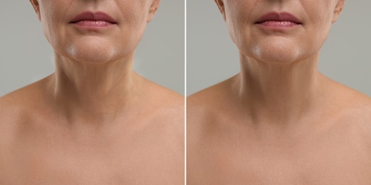 Collage with photos of woman before and after cosmetic procedure on grey background, closeup