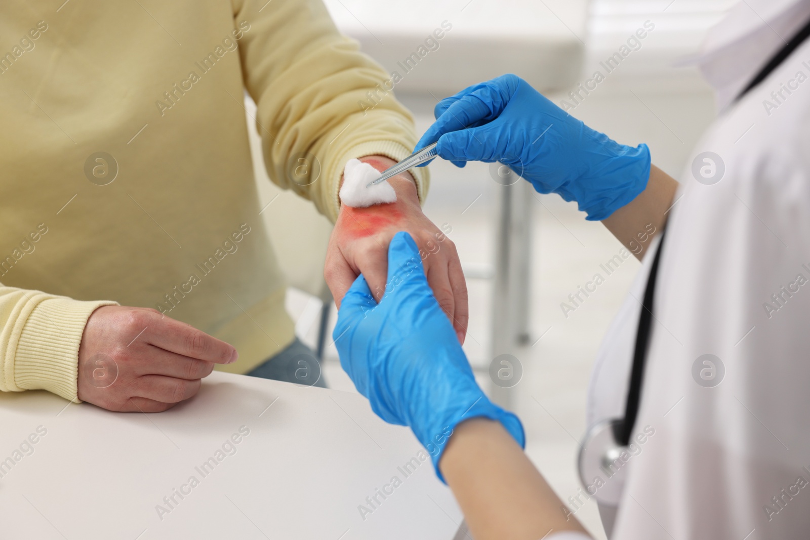 Photo of Doctor treating patient's burned hand indoors, closeup