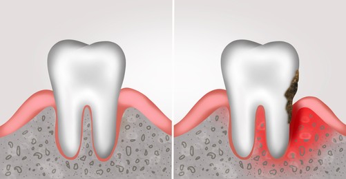 Illustration of Collage with illustrations of healthy tooth with gum and diseased ones. Gingivitis and periodontitis