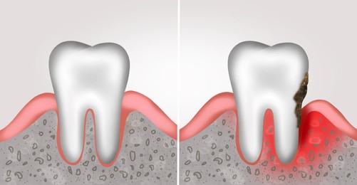 Collage with illustrations of healthy tooth with gum and diseased ones. Gingivitis and periodontitis