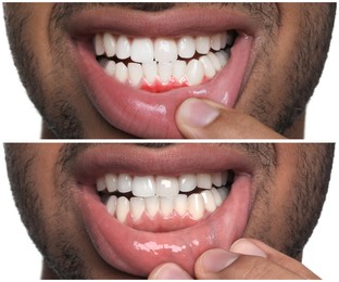 Image of Man showing gum before and after treatment on white background, collage of photos