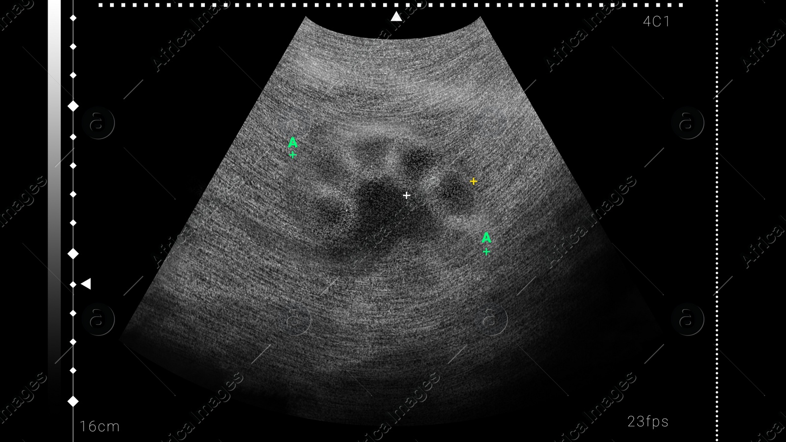 Illustration of Sonogram of human kidney, illustration. Ultrasound diagnostic