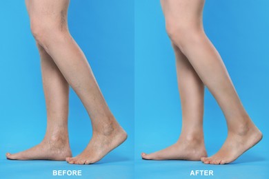 Image of Before and after varicose veins treatment. Collage with photos of woman showing legs on light blue background, closeup