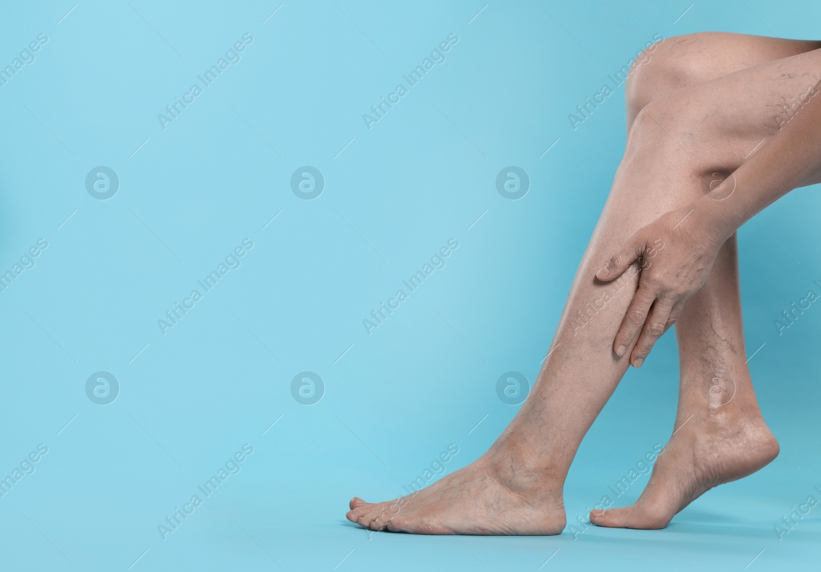 Photo of Closeup view of woman suffering from varicose veins on light blue background. Space for text