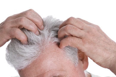 Senior man with hair loss problem isolated on white, closeup