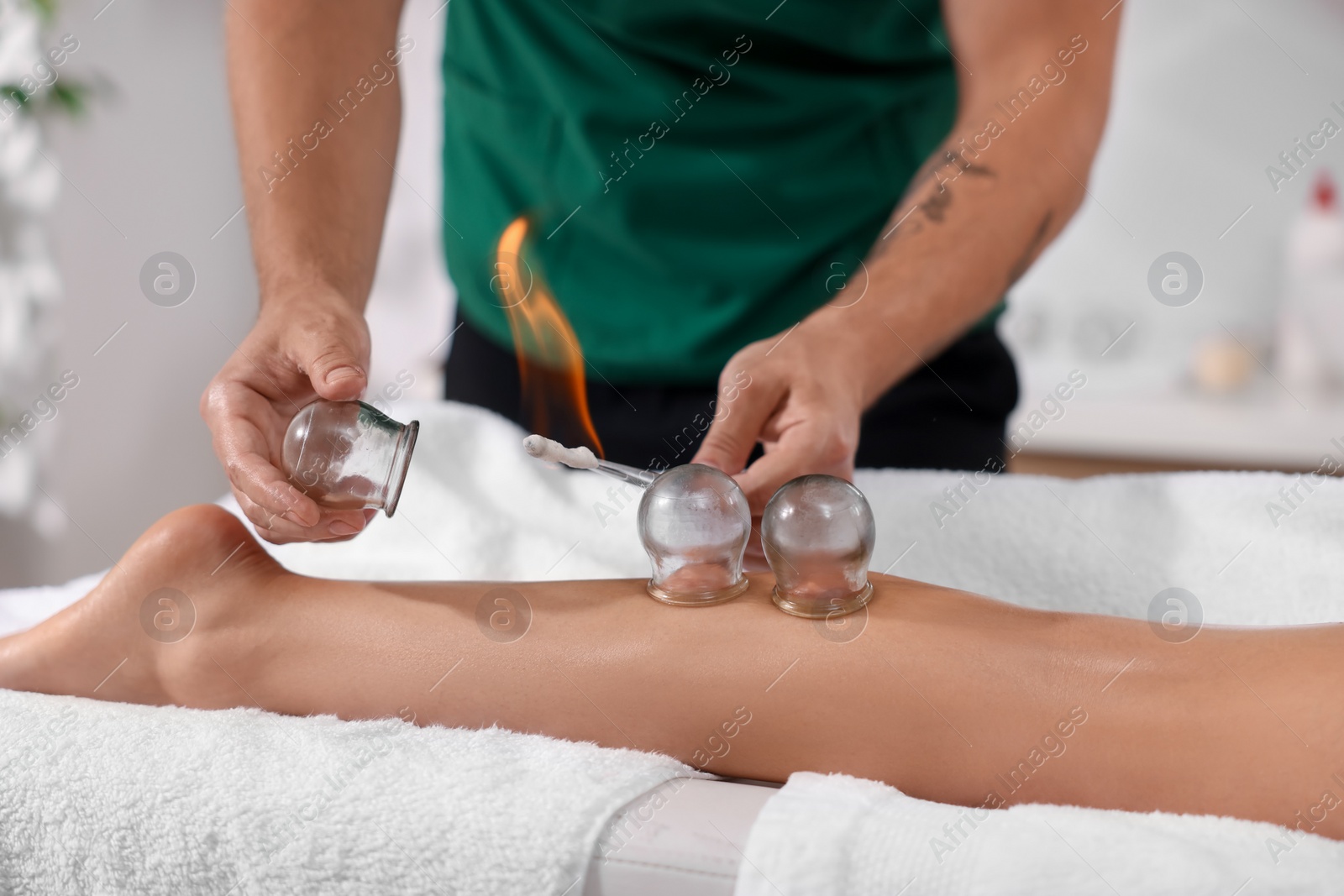 Photo of Therapist giving fire cupping treatment to patient indoors, closeup