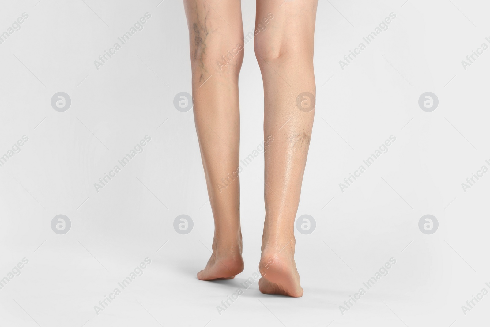 Photo of Closeup view of woman with varicose veins on light background