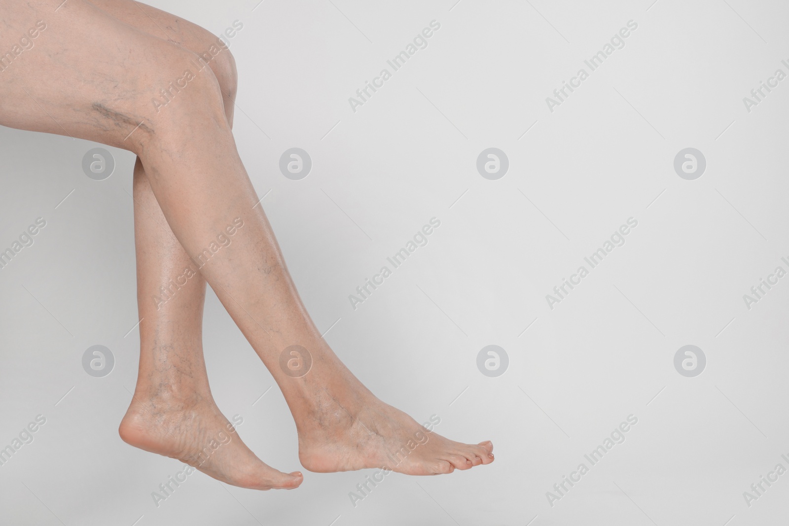 Photo of Closeup view of woman with varicose veins on light background. Space for text