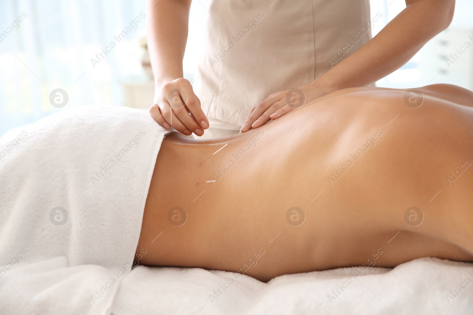 Photo of Young man undergoing acupuncture treatment in salon, closeup