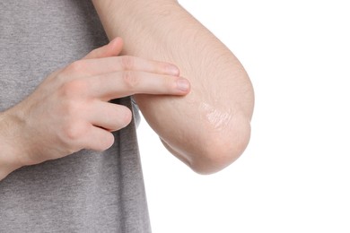 Photo of Man applying ointment onto his elbow on white background, closeup
