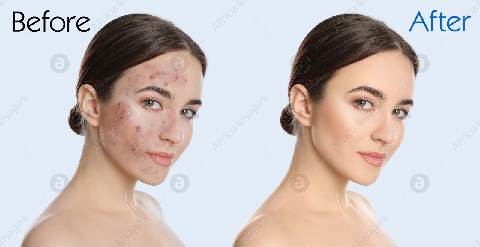 Image of Young woman before and after cosmetic procedure on light background