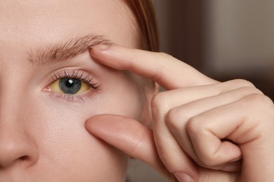 Photo of Woman with yellow eyes on blurred background, closeup. Symptom of hepatitis