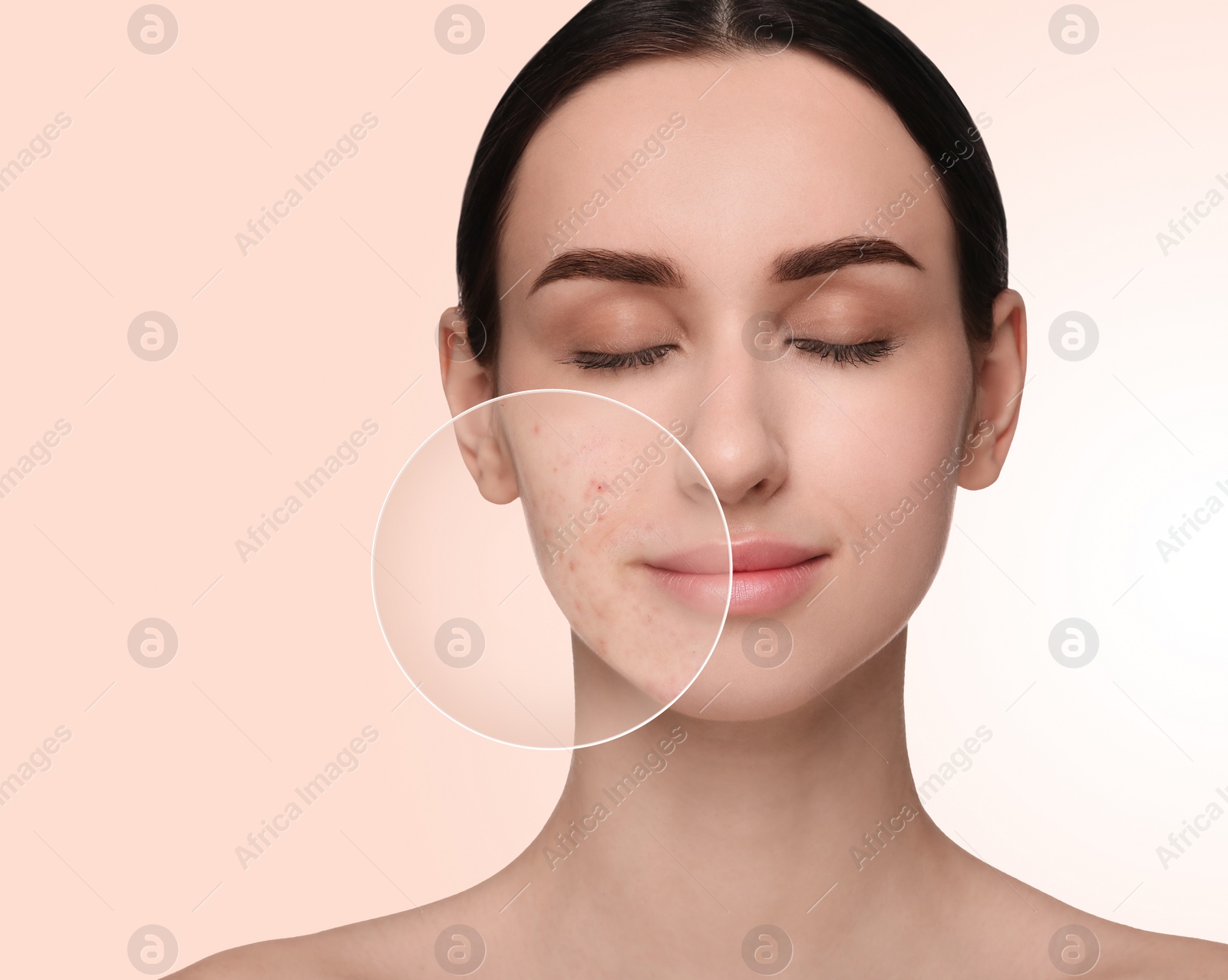 Image of Woman with acne on her face on beige background. Zoomed area showing problem skin