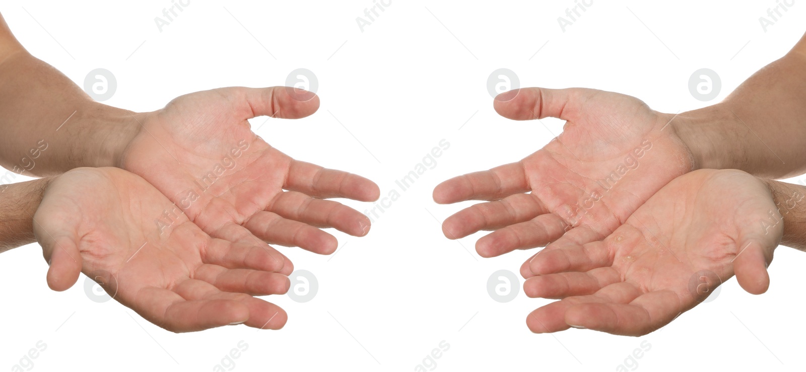 Image of Man showing hands without and with calluses on white background., closeup. Collage 