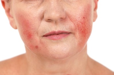 Woman with rosacea on white background, closeup. Problem skin treatment