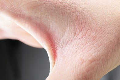 Photo of Woman with dry skin on hand, closeup