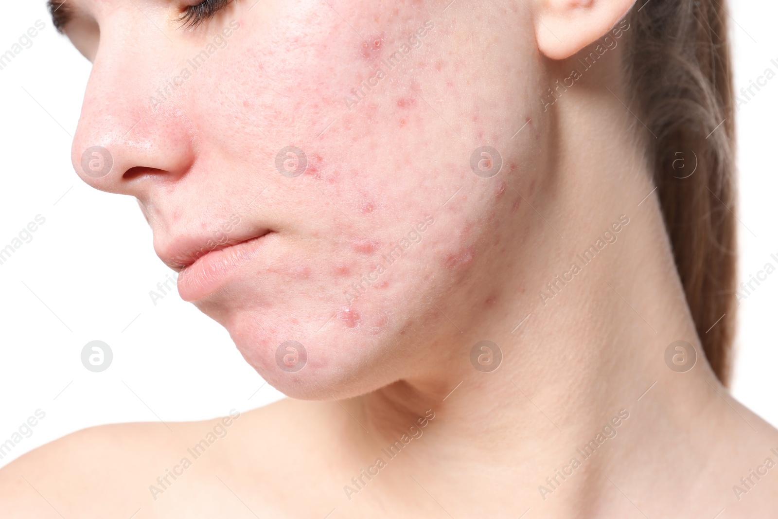 Photo of Young woman with acne problem on white background