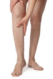 Closeup view of woman with varicose veins on white background