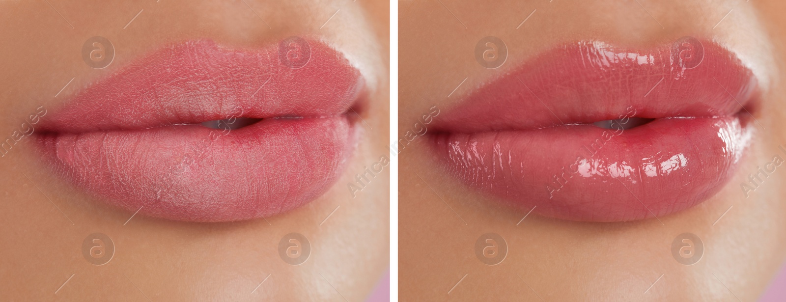 Image of Collage with photos of woman with dry and moisturized lips, closeup. Banner design