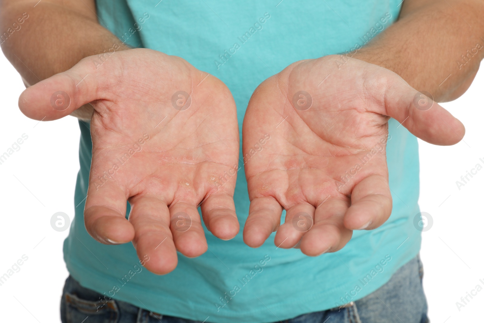 Photo of Man suffering from calluses on hands against white background, closeup