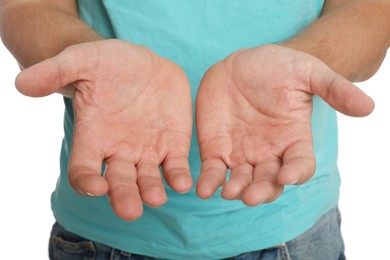 Man suffering from calluses on hands against white background, closeup