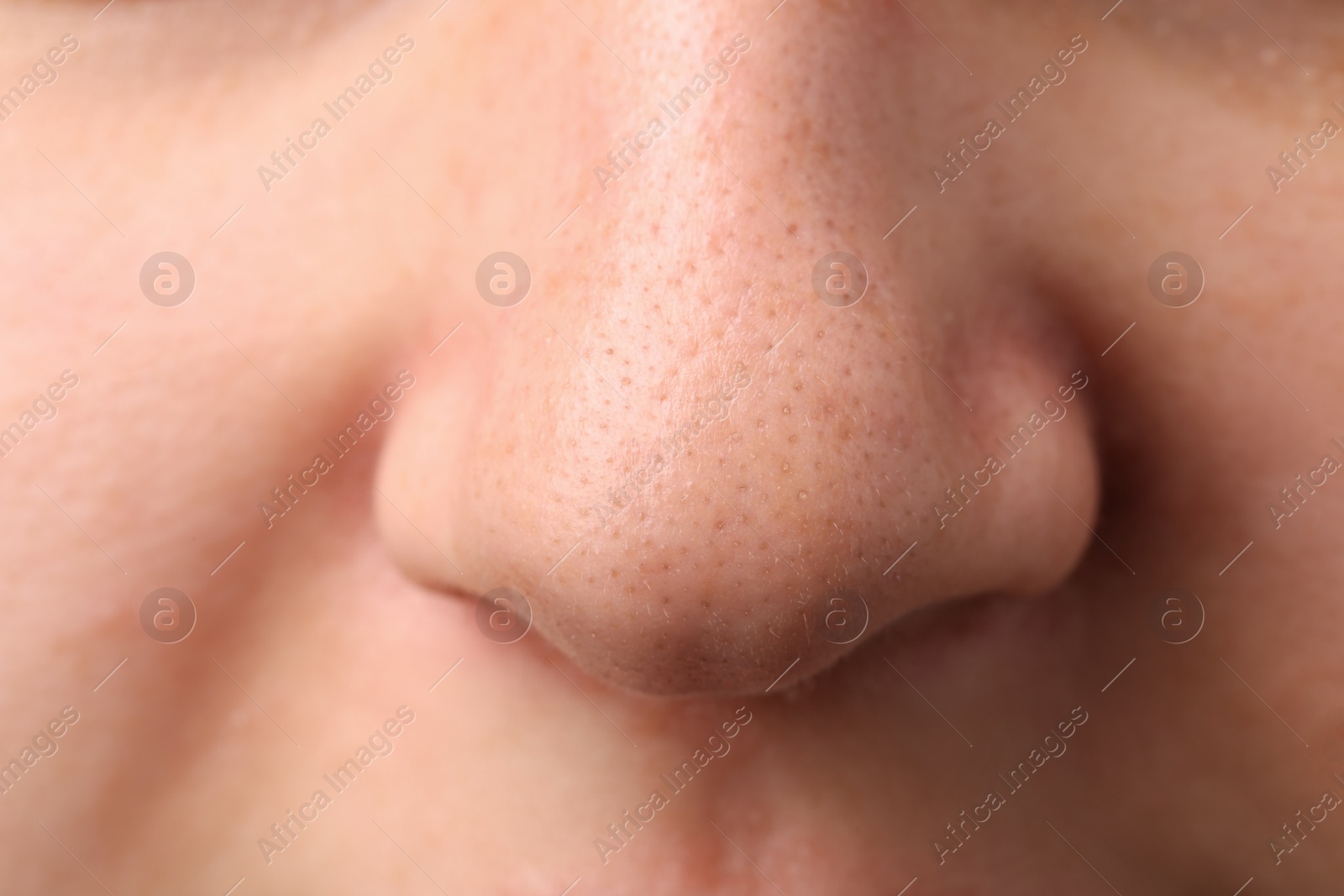 Photo of Young woman with acne problem, closeup view of nose