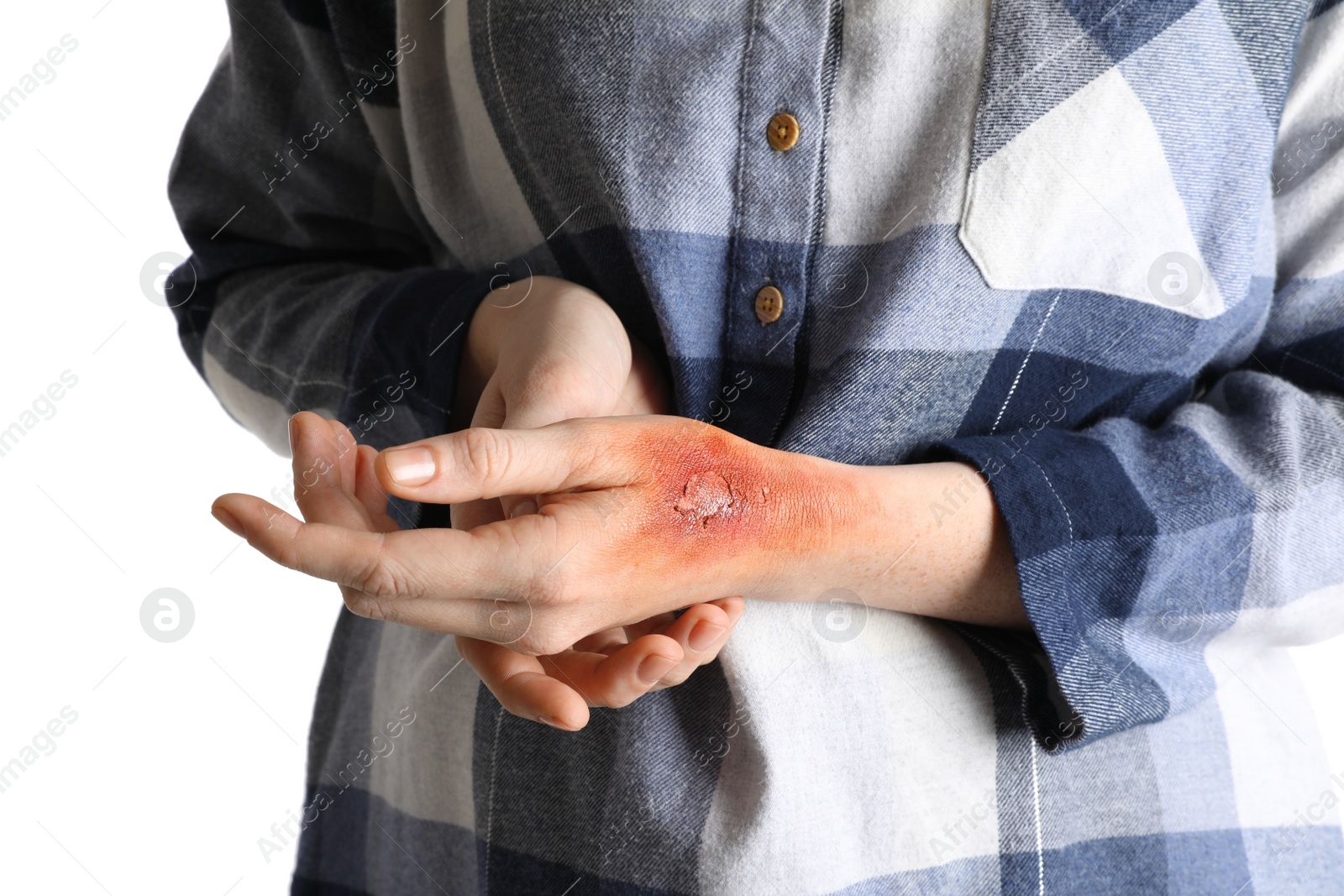 Photo of Woman with burn on her hand against white background, closeup