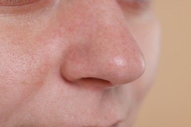 Photo of Closeup view of woman with blackheads on her nose against beige background