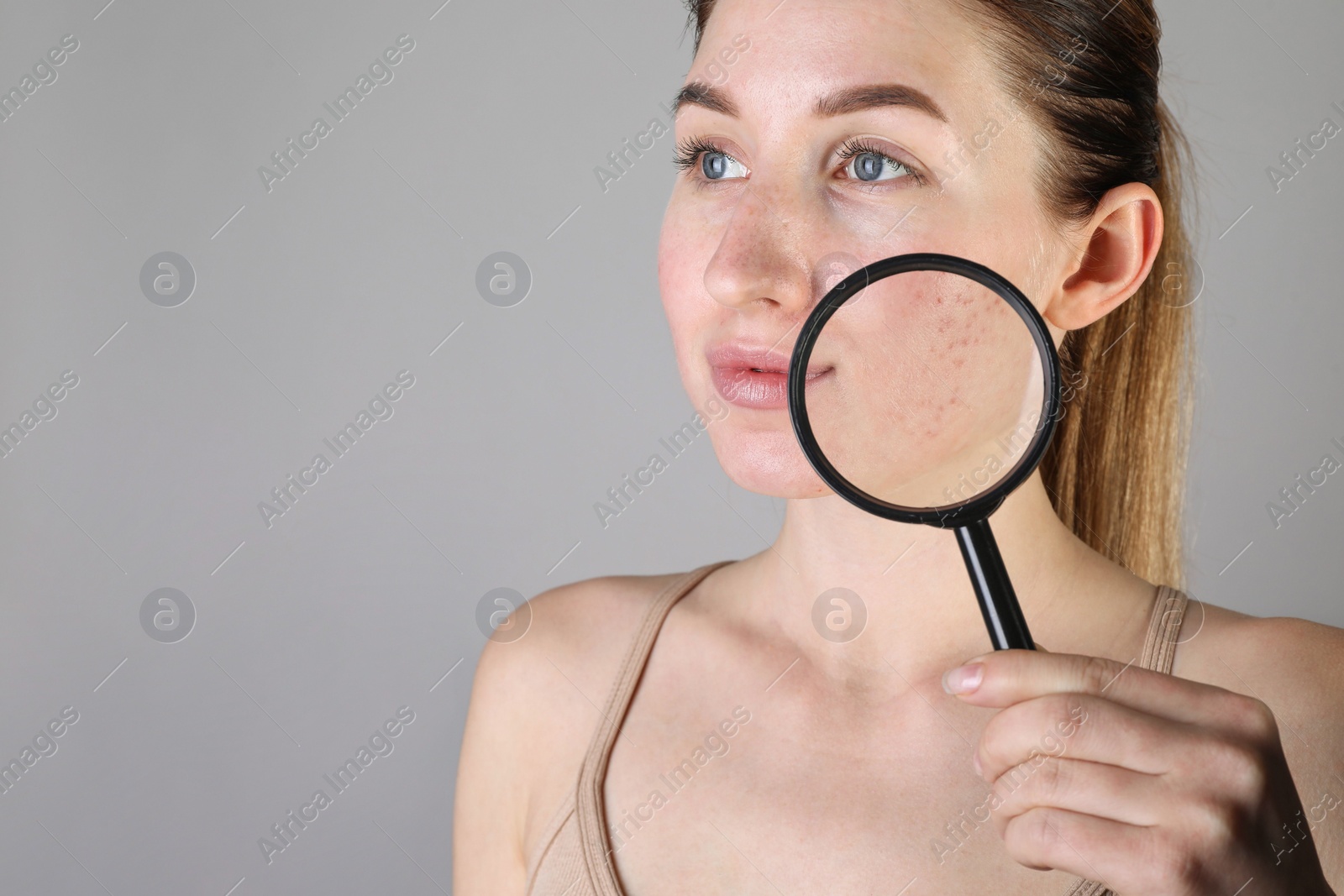 Photo of Young woman with acne problem holding magnifying glass near her skin on light grey background. Space for text