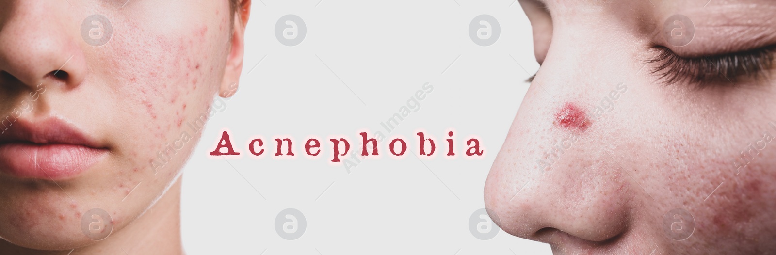 Image of Girls with problem skin, closeup. Acnephobia concept