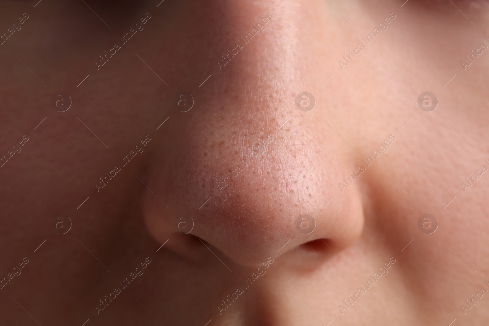 Photo of Young woman with acne problem, closeup view of nose