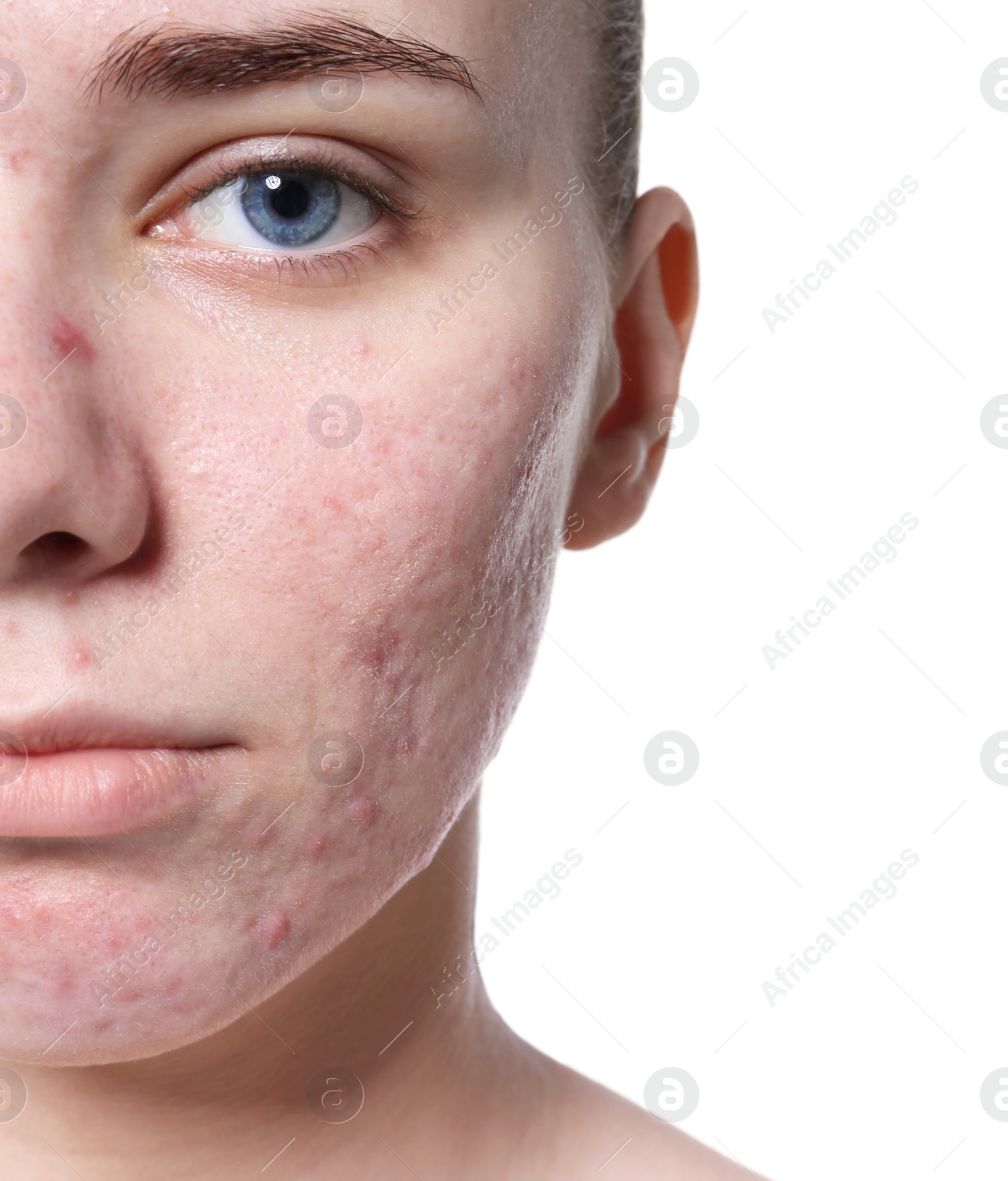 Photo of Young woman with acne problem on white background