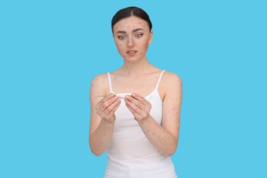 Photo of Woman with rash holding thermometer on light blue background. Monkeypox virus