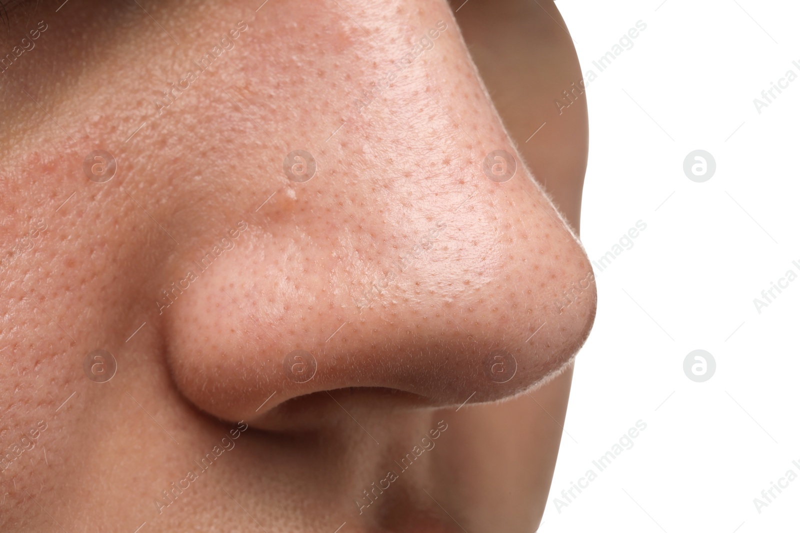 Photo of Young woman with acne problem on white background, closeup view of nose