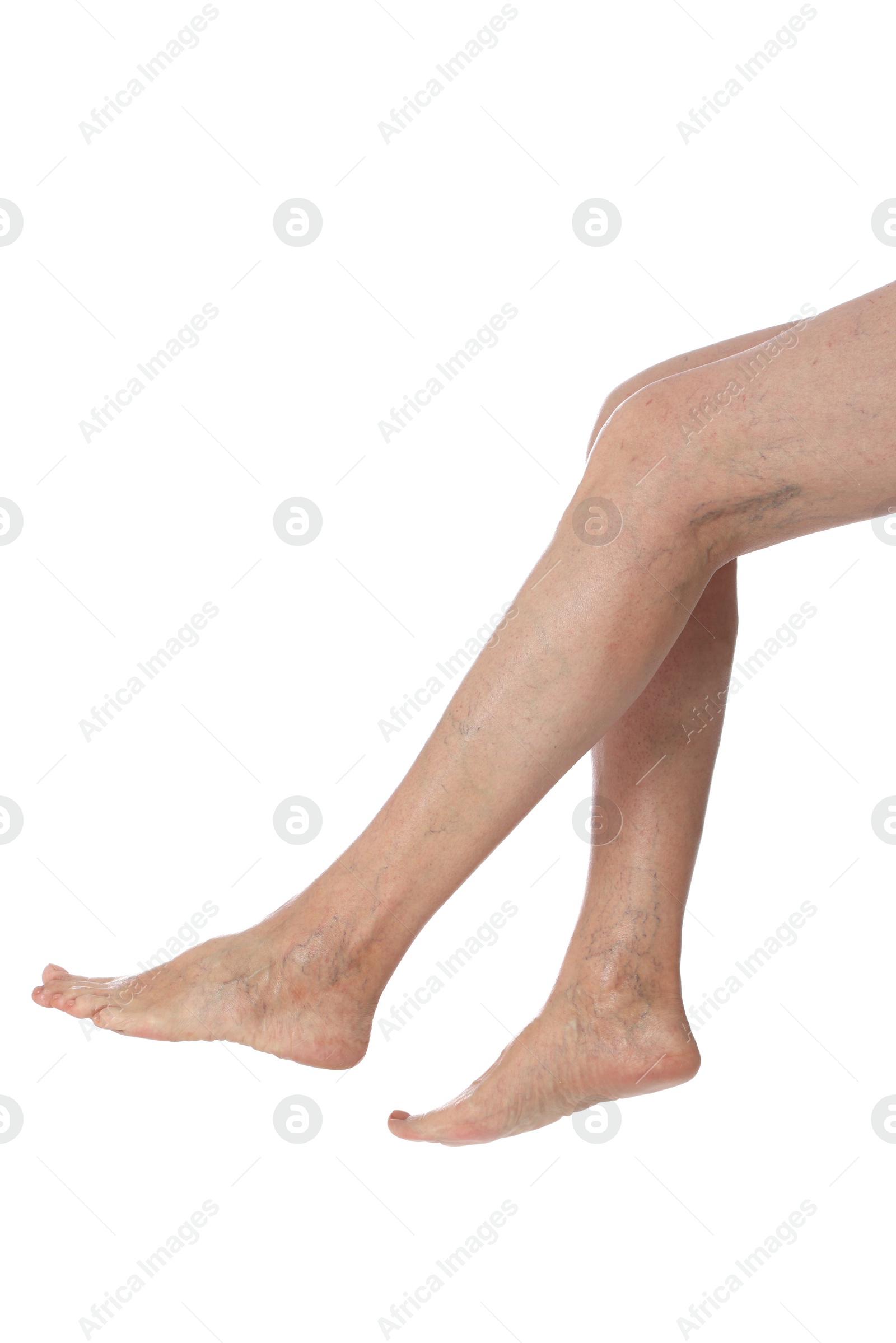 Photo of Closeup view of woman with varicose veins on white background