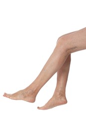 Photo of Closeup view of woman with varicose veins on white background