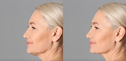 Image of Double chin problem. Collage with photos of mature woman before and after plastic surgery procedure on grey background, banner design