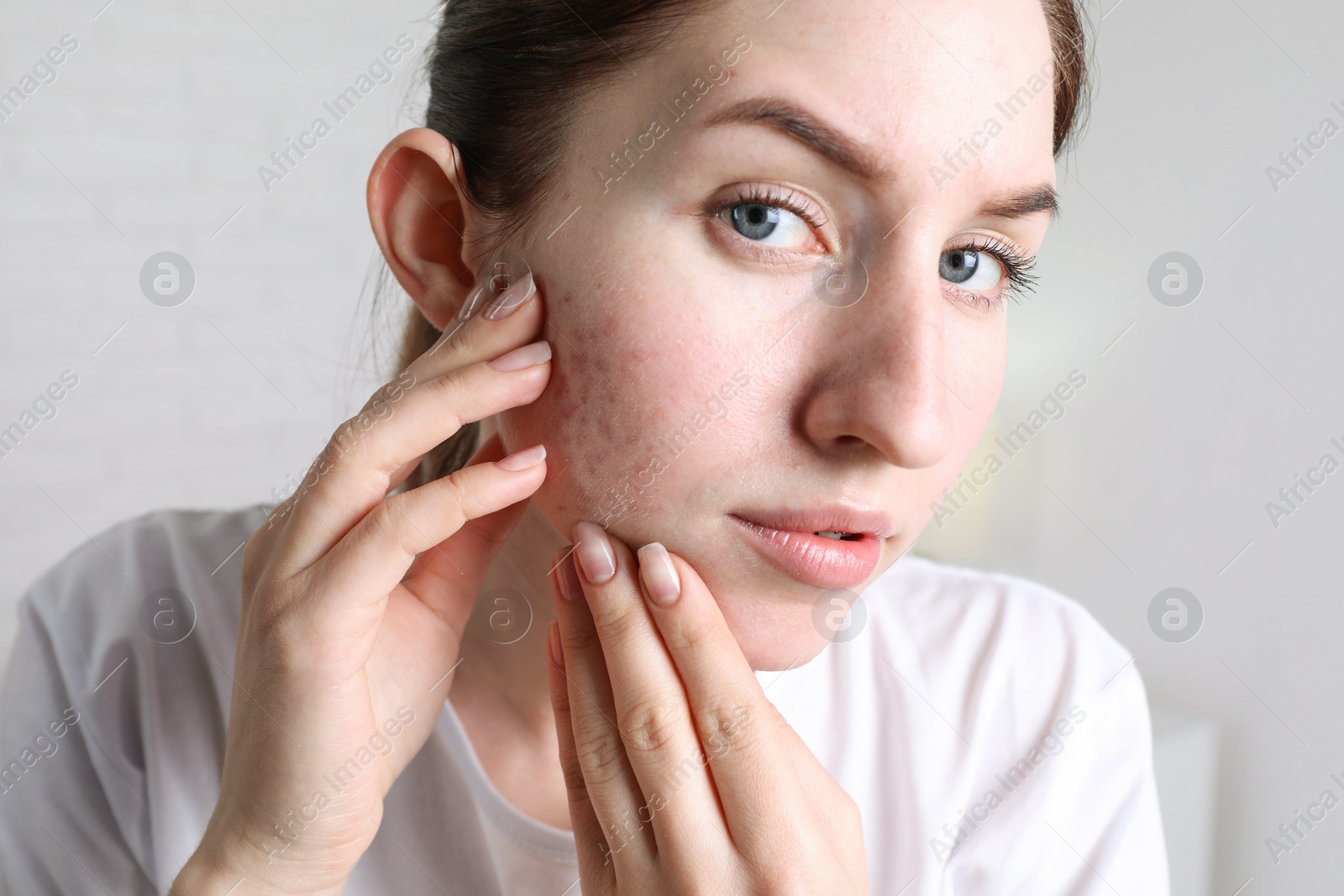 Photo of Young woman with acne problem at home