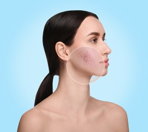 Image of Woman with acne on her face on light blue background. Zoomed area showing problem skin