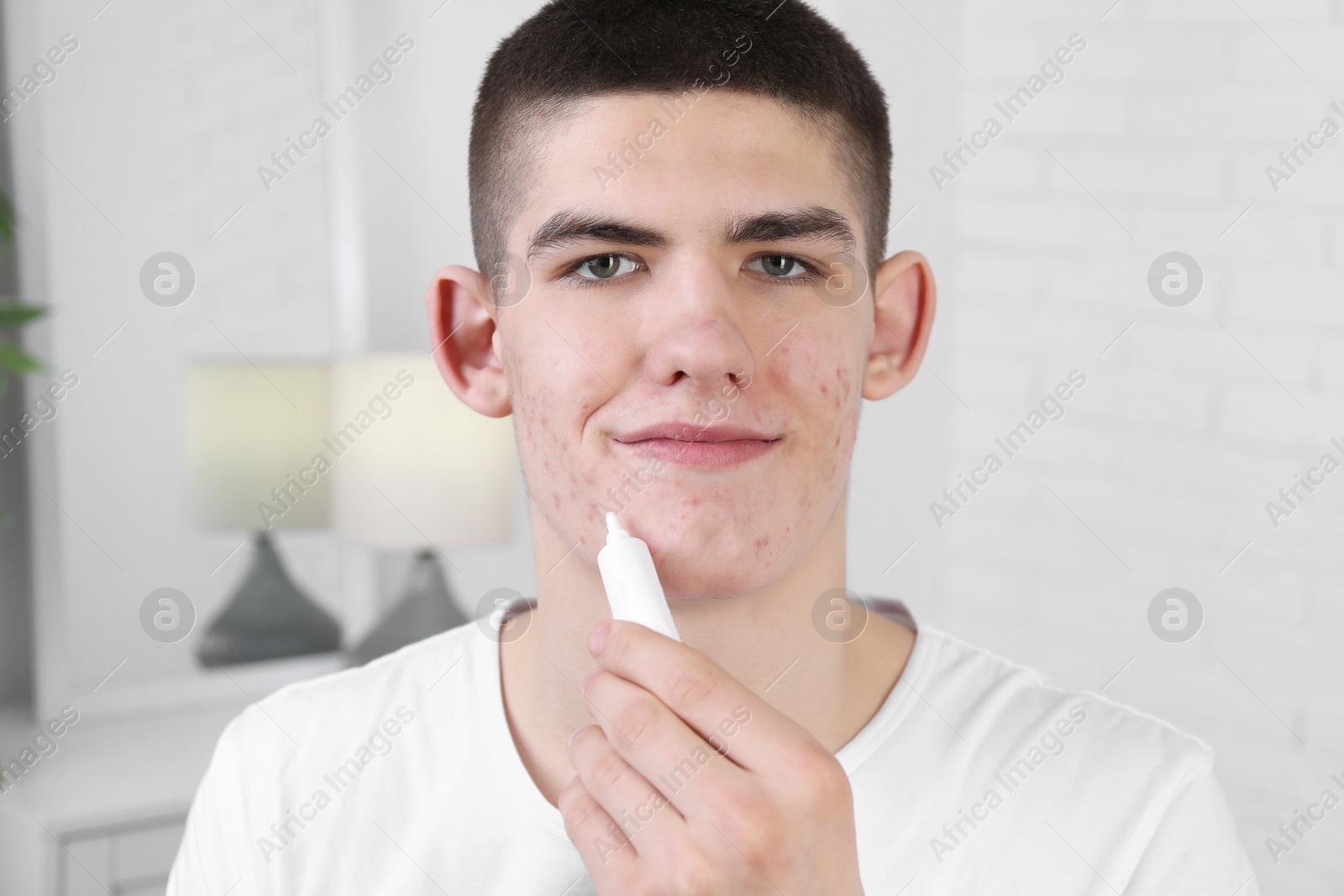Photo of Young man with acne problem applying cosmetic product onto his skin indoors