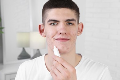 Photo of Young man with acne problem applying cosmetic product onto his skin indoors